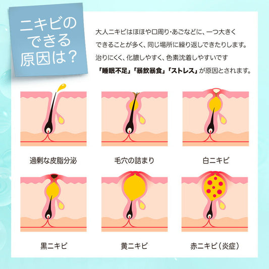 ニキビの原因とは何か——種類・できる場所・年齢別に、正しいメカニズムを解説